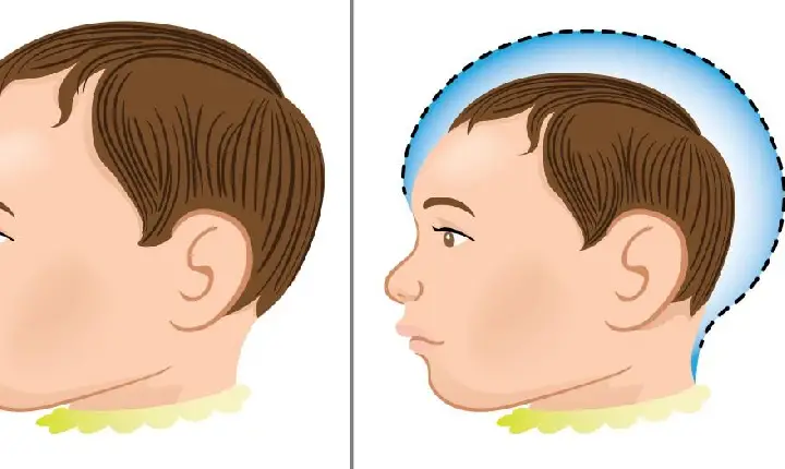 Congresso derruba veto de Lula contra pensão vitalícia a crianças com microcefalia.
